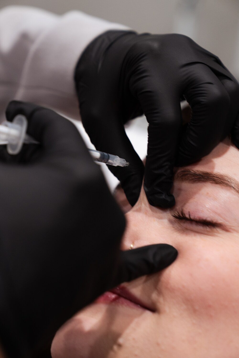 Microneedling pen treatment on forehead at REVIVE Roseburg clinic