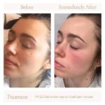 Before-and-after photos of Haley’s under-eye PRF EZ Gel treatment at Revive Infusions & Wellness, a medically supervised wellness center in Roseburg, Oregon, reducing dark circles and under-eye bags for a rejuvenated appearance.