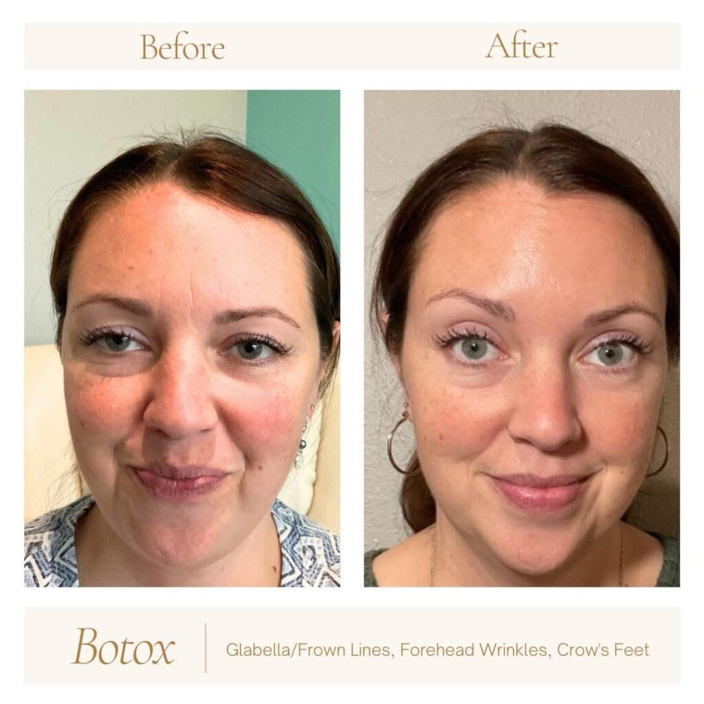 Before-and-after photo of patient Laura showing results from Botox treatments at Revive Infusions & Wellness in Roseburg, Oregon, emphasizing personalized wrinkle reduction and facial rejuvenation. Botox was applied to frown lines, forehead wrinkles, and crow's feet.