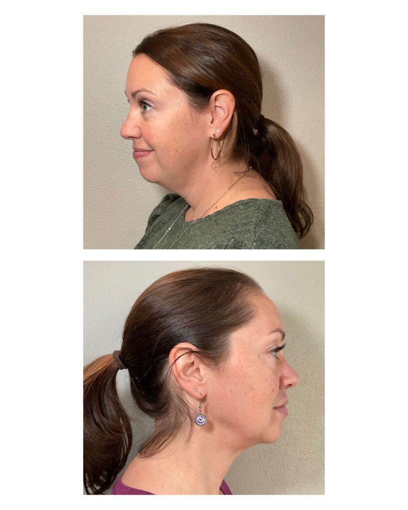 Laura has had an amazing transformation in both her weight loss and the appearance of her skin. She has used the Revive Clinical Weight Loss Program, strength and nutrition plan, PRP, botox, kybella and IV therapy. Her results are amazing. Located in Roseburg, Oregon, Revive Infusions & Wellness delivers bespoke IV infusions, nutrient therapy, and wellness optimization. We design personalized protocols based on biomarkers, health history, and goals, offering medically guided solutions for longevity, performance, immune support, and overall vitality. Side by side comparison of before and after revive PRF EZGel.