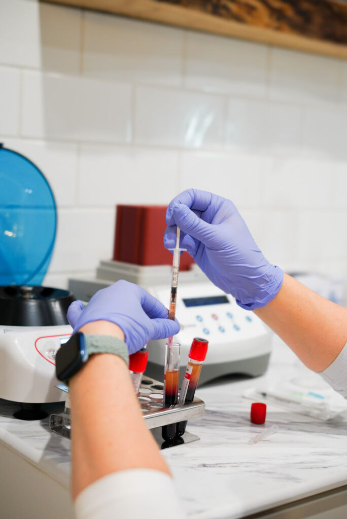 Medical professional using a syringe to uptake platelet rich plasma from patients centrifuged blood to use as an aesthetic treatment to add fullness to the skin and reverse aging. Platelet-rich fibrin therapy at Revive Infusions & Wellness in Roseburg, Oregon provides advanced regenerative skin rejuvenation using a higher concentration of natural growth factors. This image represents PRF treatment performed in a luxury medical spa serving Douglas County. PRF is commonly used for under-eye rejuvenation, facial volume restoration, and improved skin firmness. Unlike PRP, PRF releases growth factors over time for extended regenerative benefits. Clients in Roseburg seeking natural, long-lasting aesthetic results choose PRF therapy for enhanced collagen stimulation and youthful skin restoration.