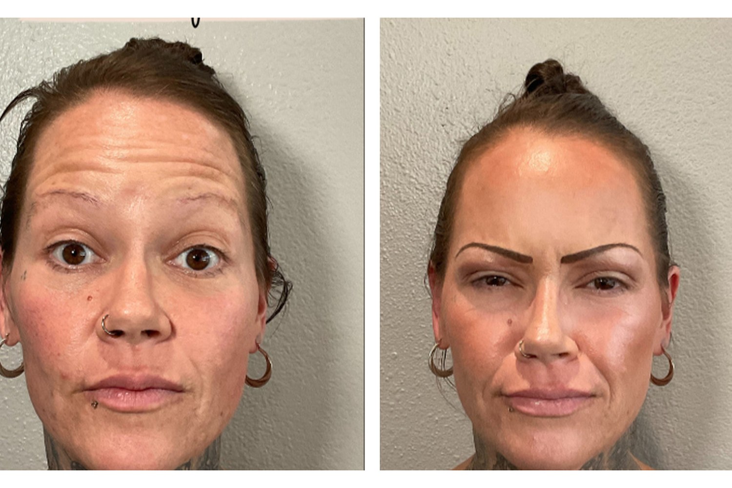 Neuromodulator before and after — REVIVE patient result 1