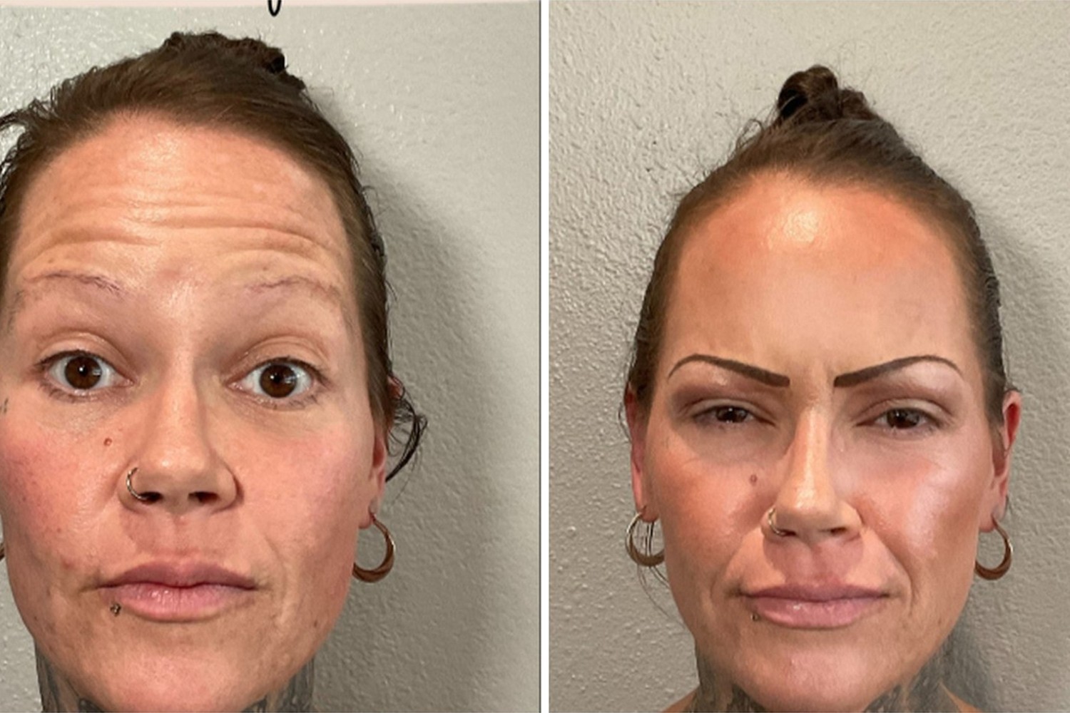 Neuromodulator before and after — REVIVE patient result 1