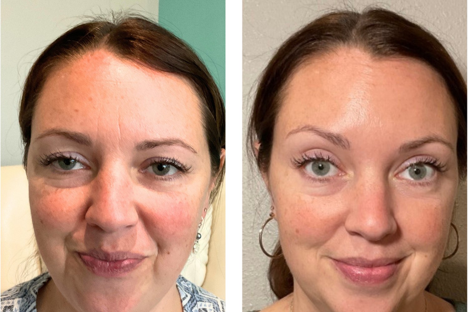 Neuromodulator before and after — REVIVE patient result 2